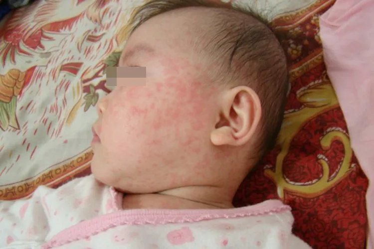 宝宝身上出现很多小红疹图片