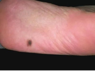 交界痣黑痣图片