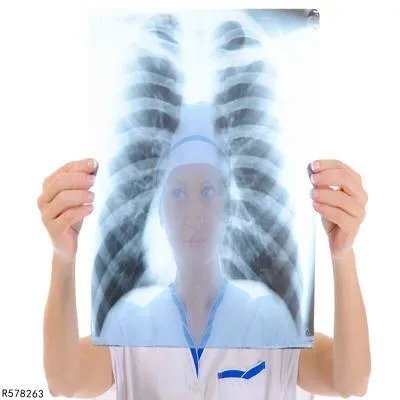 肋骨软骨炎的检查方法有哪些