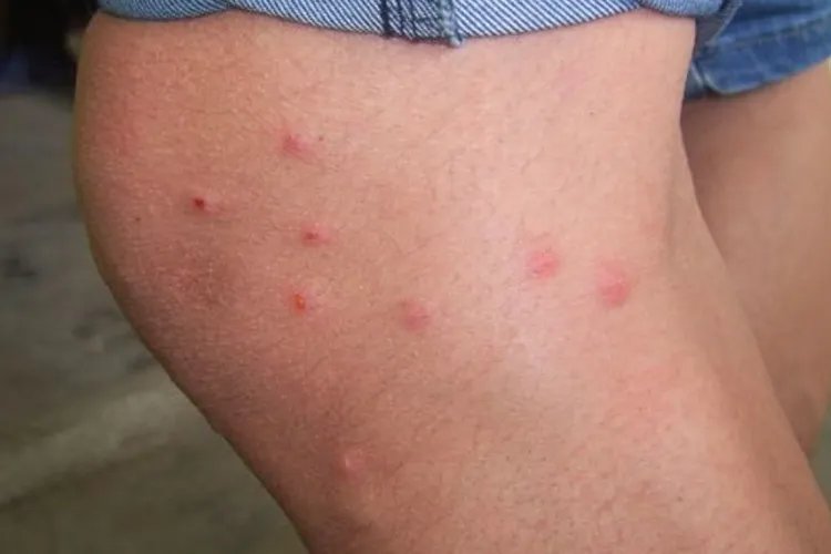 结节性痒疹图片