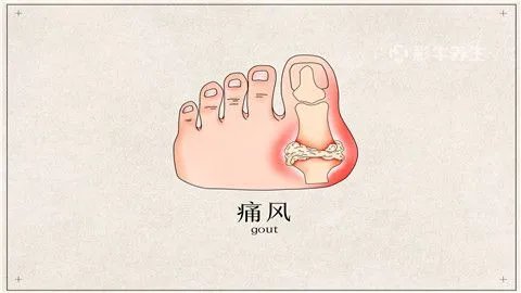 痛风怎么治疗最有效的方法