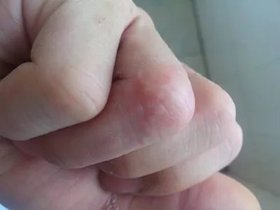 手部湿疹红斑图片