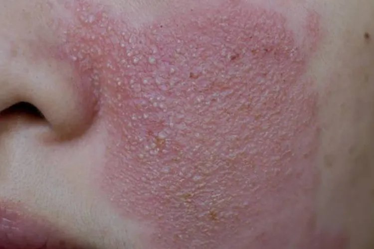 小皮疹图片大全