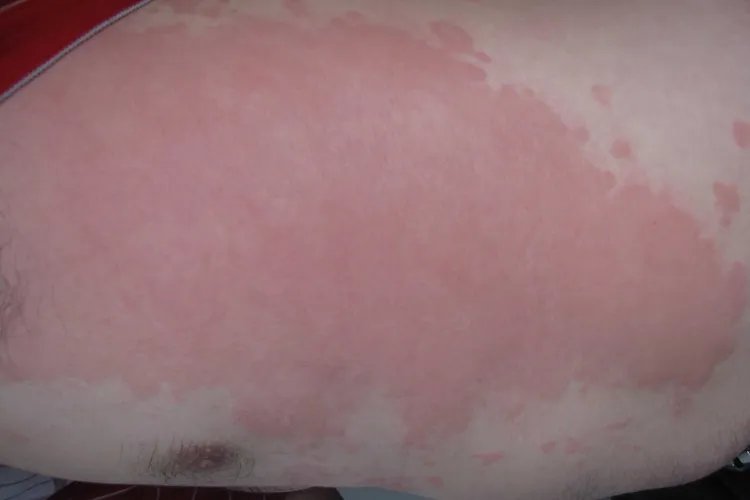 常见皮肤病对照图