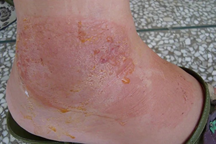 脚部皮炎图片和症状