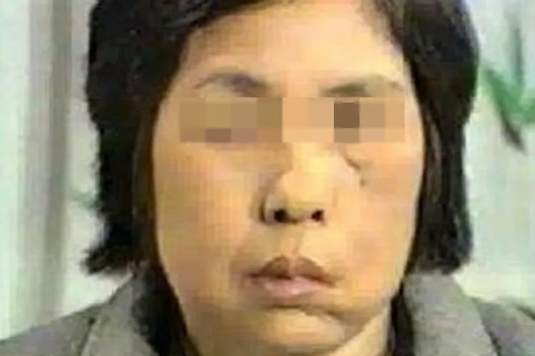 面瘫的症状图片