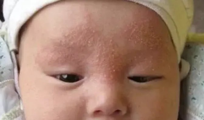 奶癣小红疙瘩图片