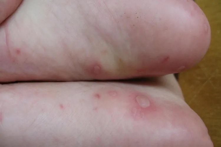 什么是手足口病图片