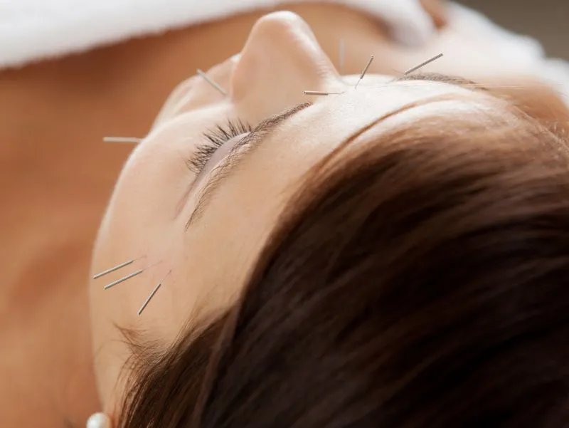 针炙的功效与作用