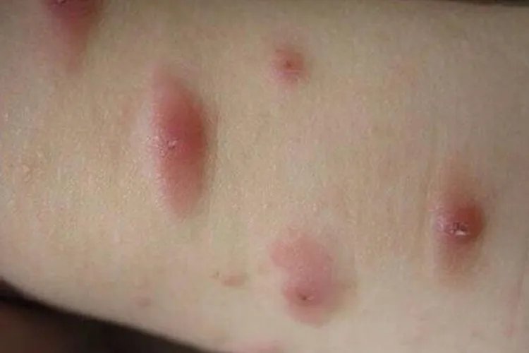 儿童被螨虫叮咬后的症状图片