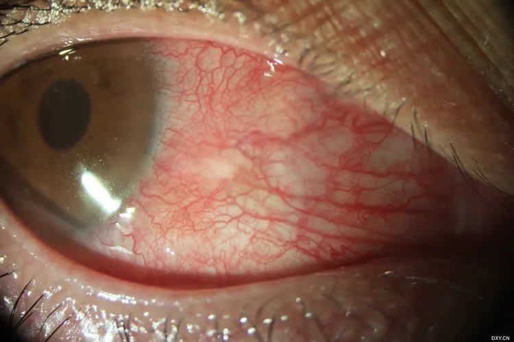 沙眼图片和正常眼睛图片对比