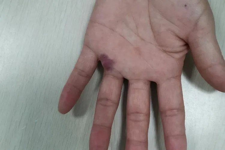 轻度红斑狼疮图片