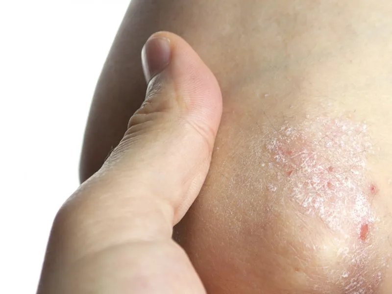 珊瑚癣净的作用