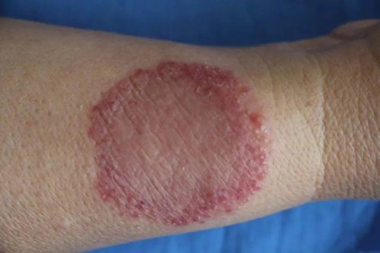 圆圈一样的疱疹图片