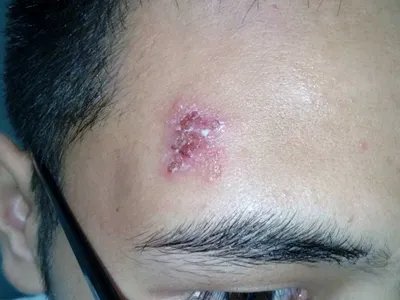 单纯疱疹水疱图片