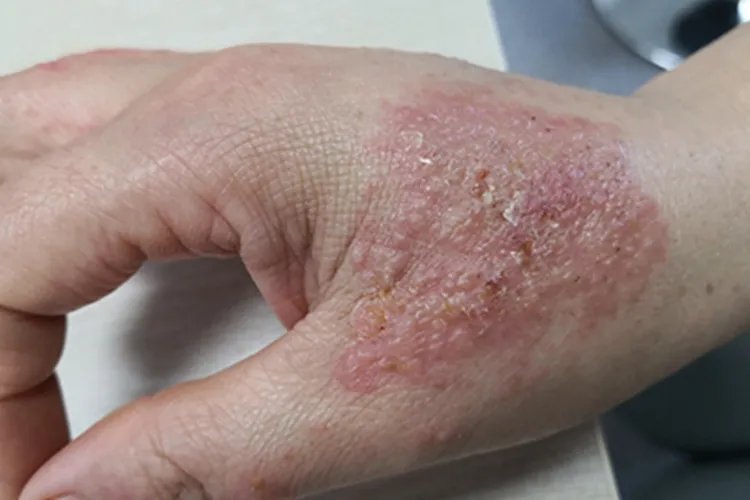 湿疹手部症状图片