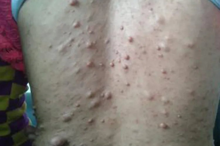 皮下脂肪瘤图片