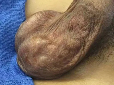 精索静脉曲张症状图片