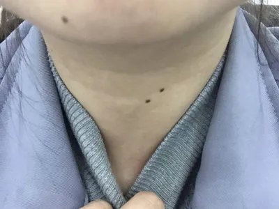 交界痣黑痣图片