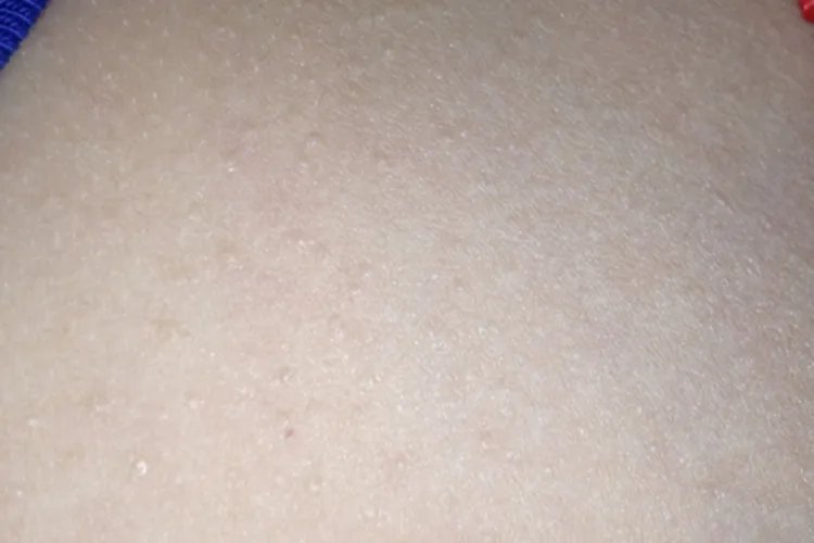 痱子长啥样图片