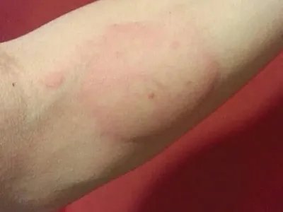 成人痒疹风团图片