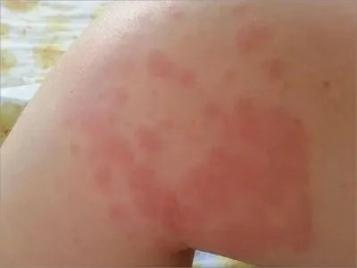 运动诱导性荨麻疹症状图片