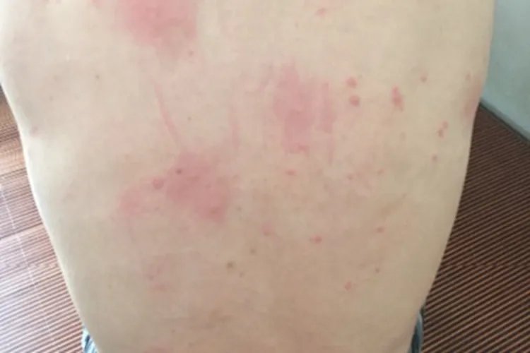 跳蚤叮咬红点图片