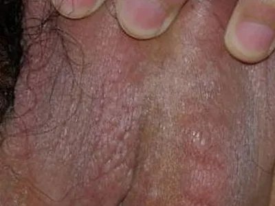 精索静脉曲张症状图片