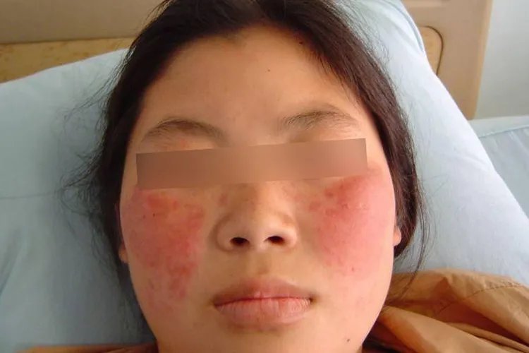 轻度红斑狼疮图片