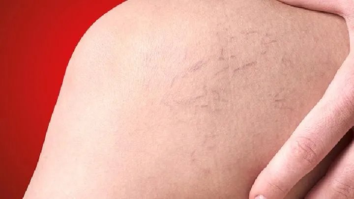 静脉曲张的症状有什么