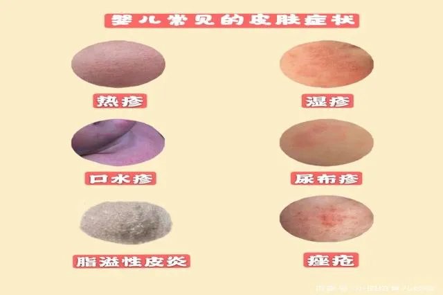 过敏湿疹和热疹的区别图片