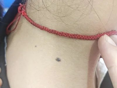 交界痣黑痣图片