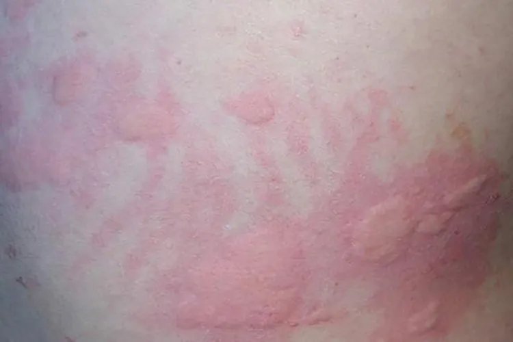 各种荨麻疹图片大全
