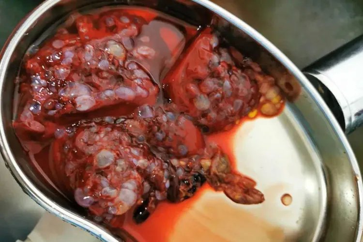 葡萄胎婴儿真实图片