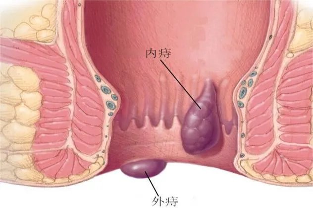 痔疮长什么样