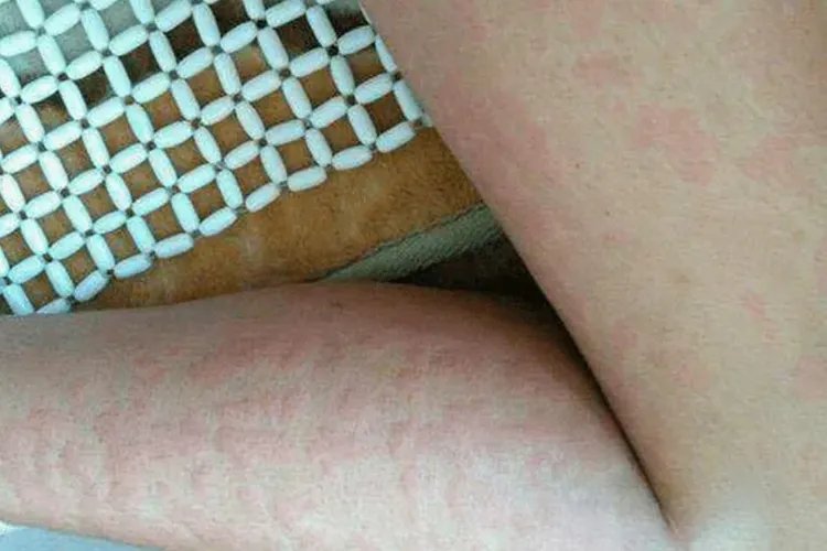 各种荨麻疹图片大全