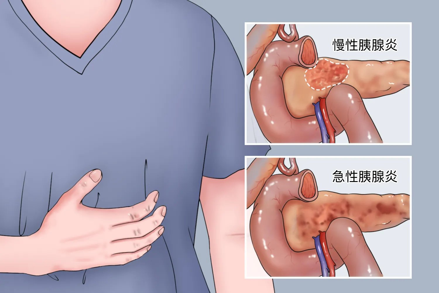 胰腺部位图片大全