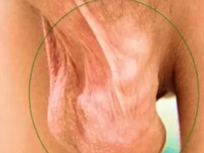 精索静脉曲张症状图片