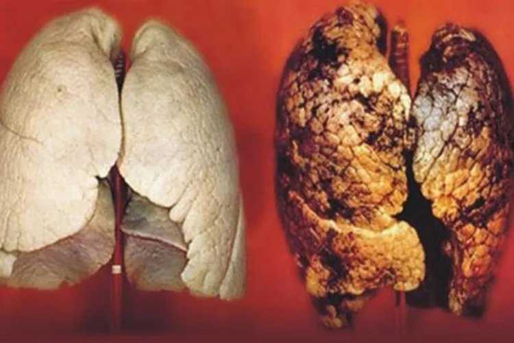抽烟的肺图片