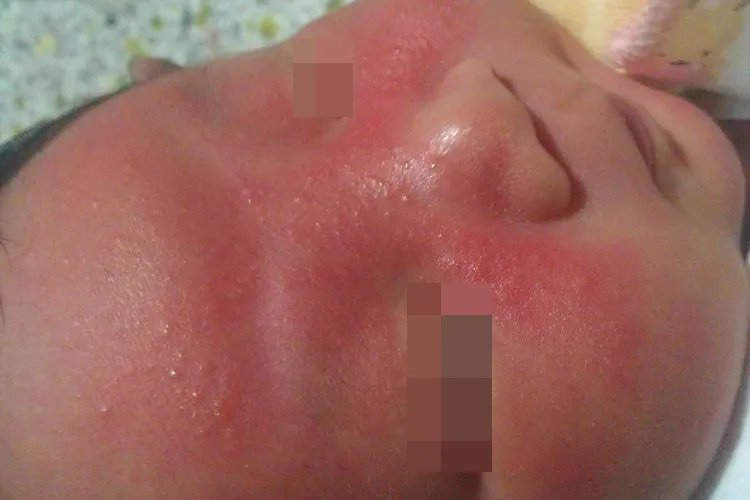 新生儿湿疹初期症状图片大全
