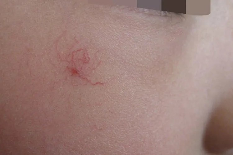 蜘蛛痣特征图片