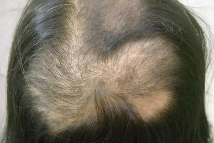 拔毛癖严重后果是什么样的