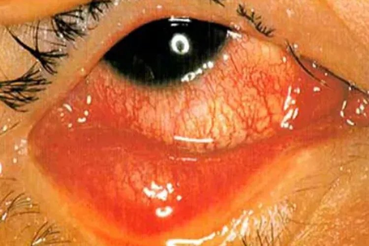 红眼病图片