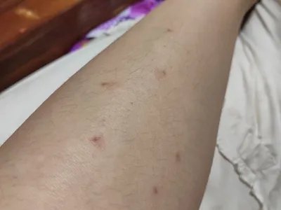 跳蚤叮咬丘疹图片