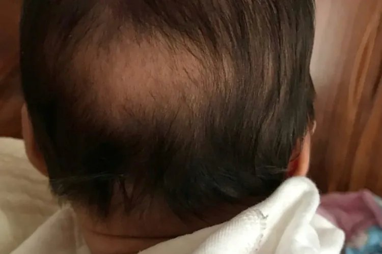 新生儿佝偻病图片