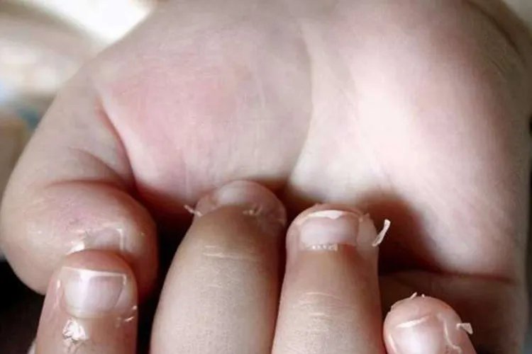 婴儿长肉刺图片