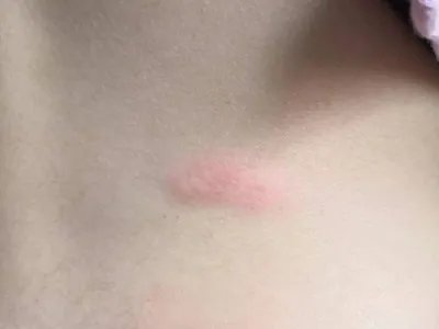 成人痒疹风团图片