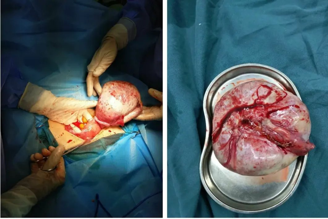 良性卵巢畸胎瘤图片