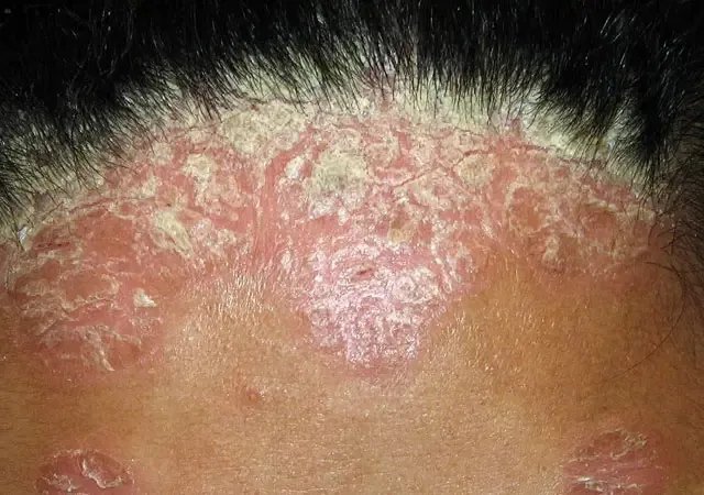 头皮屑症状图片