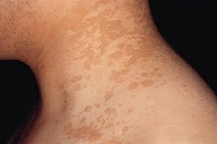 脖子上花斑癣图片大全